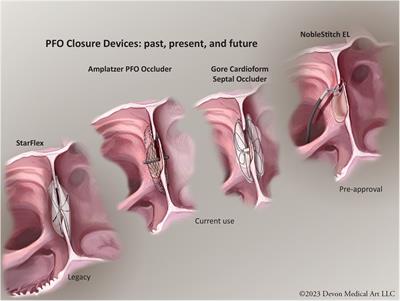 Transcatheter PFO closure for cryptogenic stroke: current approaches and future considerations